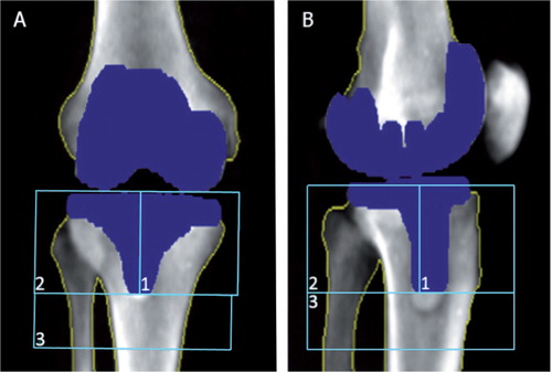 Figure 2. DXA scans showing implant detection, bone borders, and regions of interest (ROIs). A. Anterior/posterior view. B. Lateral view.
