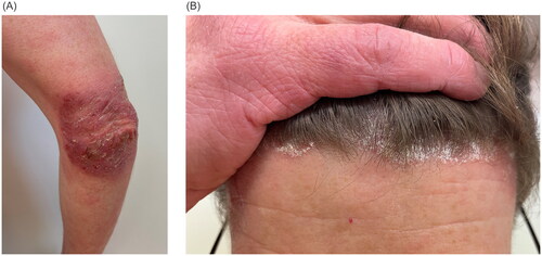 Figure 2. Clinical presentation of paradoxical tralokinumab-induced psoriasis with red, scaly plaques on the elbows (A) and erythematous patches at the hairline covered by silvery-white scales (B).