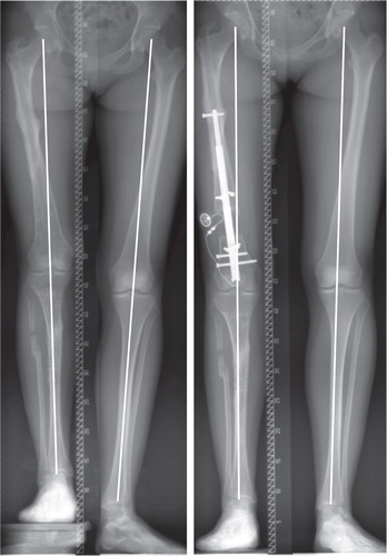 Figure 1. Femoral lengthening with a retrograde intramedullary nail (nail group: pair 6).
