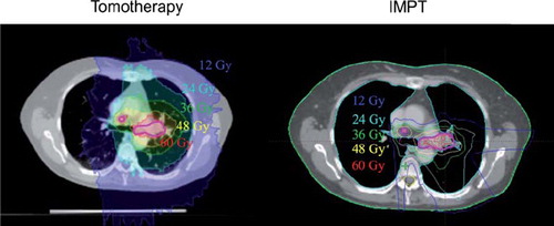 Figure 1. An illustrative case of the intensity modulated photon plan (left) and proton plan (right). The Tomotherapy plan provides very high conformality at the expense of large low dose volumes of the lung. The proton IMPT plan, however, provides conformal target coverage with very little exposure of the residual lung. The bold purple line is the target volume prescribed to 60 Gy.