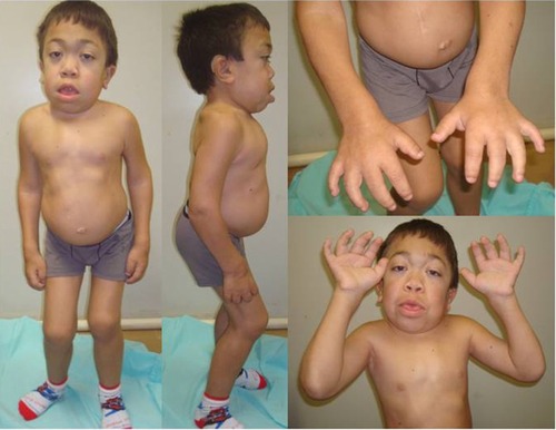 Figure 1 Male patient (14 years old) with the rapidly advancing form of MPS VI.