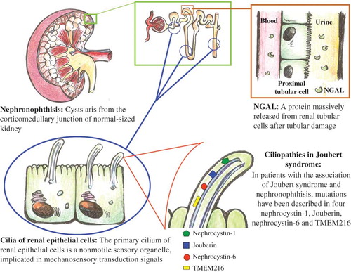 Figure 2. JBTS, tubular damage, and NGAL. The gene products associated with Joubert syndrome are known to localize to primary cilium. Its disruption leads to cystic kidney disease. The increase in NGAL values may express the degree of subclinical tubular impairment, thus representing an earlier measurable index of renal suffering.Note: JBTS, Joubert syndrome; NGAL, neutrophil gelatinase-associated lipocalin.