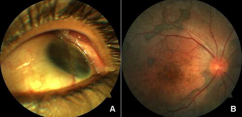 Figure 3 (A) Anterior segment photo shows a phthisical eye with evidence of repair of globe rupture. (B) Posterior segment photo of the other eye shows depigmented fundus (sunset glow) with areas of fibrotic pigmentary changes.