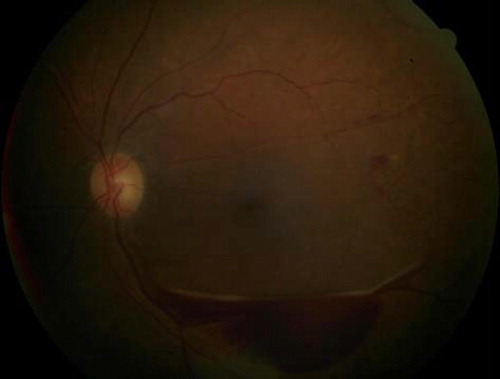 Figure 5. Well circumscribed sub-hyaloid hemorrhage in a patient with proliferative diabetic retinopathy.