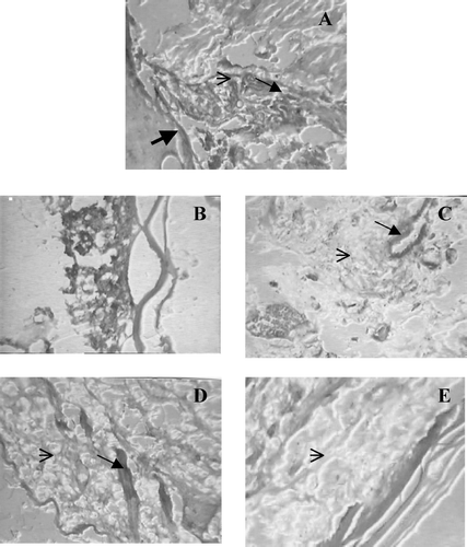 FIG. 6 Histopathological effects from the various treatments. On Day 21 synovial joint sections of treated and untreated CFA arthritis animals stained with hematoxylin-eosin. A. Shows typical pathological changes in arthritic joint with bone destruction, cartilage erosion, severe angiogenesis and infiltration of lymphocytic cells. B. Normal synovial joint. C. Shows less angiogenesis and mild lymphocytic infiltration by dexamethasone treatment. D. MO1 shows less lymphocytic infiltration but does not protected joint against angiogenesis. E. MO2 shows significant protection against lymphocytic infiltration, bone destruction and cartilage erosion. Display full sizeindicates angiogenesis, ↑ indicates lymphocytic infiltration, and Display full size shows bone and cartilage destruction.