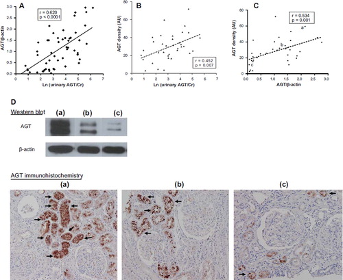 Figure 1. The urinary excretion of AGT reflected renal AGT expression. A: Ln (urinary AGT/Cr) was significantly and positively correlated with AGT/β-actin measured using Western blotting (n = 63). B: Ln (urinary AGT/Cr) was significantly and positively correlated with kidney AGT density measured using immunohistochemistry (n = 35). C: There was a significant positive correlation between AGT/β-actin and kidney AGT density (n = 35). D: Representative Western blots and tissue sections showing AGT expression. Arrows indicate the AGT-stained tubules. (a) High expression of AGT; (b) intermediate expression of AGT; (c) low expression of AGT; magnification ×200 (AU = arbitrary unit).
