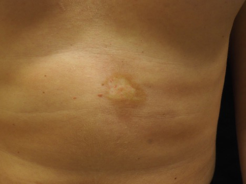 Figure 8 Plaque morphea is a subtype of morphea characterized by <3 plaques and <3 centimeters in size.