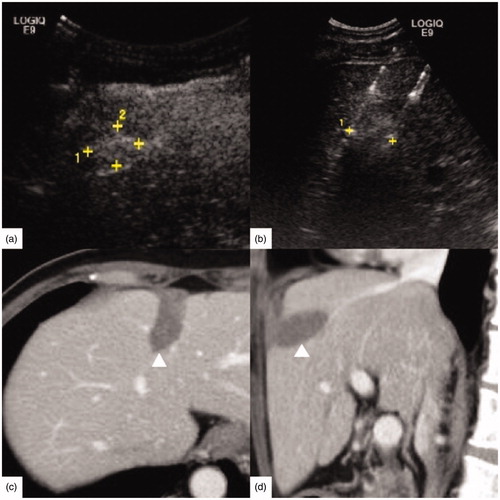 Figure 3. A 63-year-old female had rectal carcinoma with liver metastasis. CEA was 5.27 ng/ml, CA-199 was 143.8 U/ml and α-AFP was 2.10 ng/ml. (a) Contrast-enhanced ultrasound (CEUS) before RFA showed the tumor size was 2.4 × 1.6 cm. (b) RFA was performed with three 3 cm tip RF electrodes and the distance of electrodes was 1.3 cm. Contrast enhanced computed tomography in one month on axial section (c) and sagittal section (d) showed the ablation zone (△) had no enhancement and the ablation zone was approximately ellipsoid. The length, width and thickness of ablation zone was 2.8 cm, 2.0 cm, 1.9 cm, respectively.