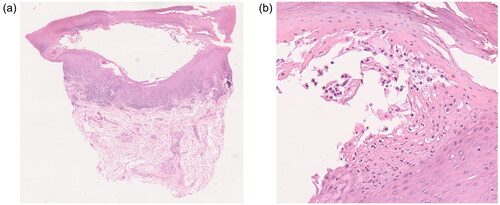 Figure 2. (a) A thick stratum corneum with incomplete keratinization and underlying pustules are seen, and a dense cellular infiltrate is seen in the surrounding area. (b) Numerous neutrophils collect in the upper epidermis from the stratum corneum down to the stratum corneum, forming large pustules. Kogoj’s spongiform pustule is formed in the surrounding epidermis.