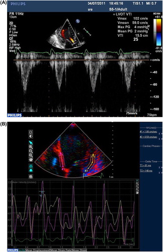 Figure 1. Echocardiography taken during implantation. aVTI of at least three beats were averaged (A). Myocardial velocity curves obtained and Ts measured in each segment from 4-chamber view (B).
