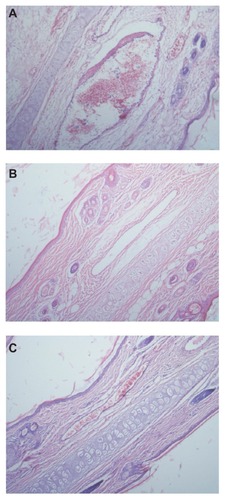Figure 8 Pathological paraffin sections (hematoxylin-eosin stain) from the ears of rabbits (×100 magnification). (A) Ear sample from rabbit given the NIM injection, showing vasodilation, hemorrhage, and degeneration around and of the vein wall as well as edema around the vein, inflammatory cell infiltration around the vein, and endothelial cell swelling. (B) Ear sample from rabbit given NIM-EPC-SGC-MMs. (C) Ear sample from rabbit given sodium chloride injection. The phenomenon shown in (A) was not observed in (B) or (C).Abbreviations: NIM, nimodipine; NIM-EPC-SGC-MMs, nimodipine-egg phosphatidylcholine-sodium glycocholate-mixed micelles.