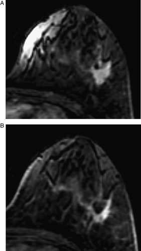 Figure 5.  MRI before (A) and after (B) chemotherapy in a case showing a rim pattern of the tumor response. The mass, measuring as 1.8×2.0 cm before chemotherapy (A), decreased to 1.0×1.2 cm and showed a rim pattern on MRI after chemotherapy (B). The pathologic finding was IDC and measured 3.5 cm.