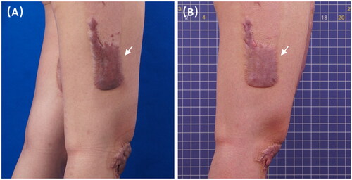 Figure 6. A 29-year-old female with hypertrophic scars from skin graft surgery on lower limbs at (A) baseline and (B) 3 months after three IPL treatments showing good improvement in vascularization and stiffness.