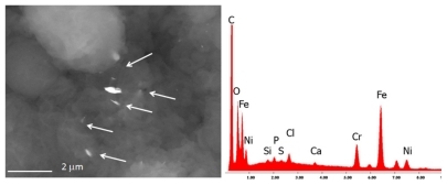 Figure 3 The bone marrow sample shows the presence of many nanoparticles (range 150 nm–5 μm) composed of iron, chromium, and nickel, namely debris of stainless steel.