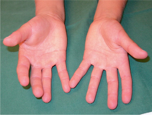 Figure 2. Slight swelling of the thenar region of the right hand.