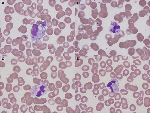 Figure 1. Peripheral blood smear showing thrombophagocytosis in a patient with pyelonephritis: (A) monocytic and (B–D) neutrophilic thrombophagocytosis.