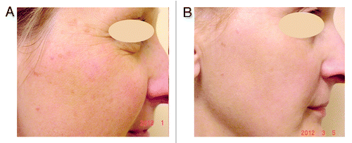 Figure 1. 45-y-old female with signs of photoaged skin: dyschromia of the skin, multiple lentigines. (A) before, (B) after one treatment with IPL with 550 nm cut-off filter.