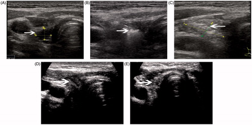 Figure 1. A 47-year-old woman had a recurrent lymph nodule in the right neck level 3 confirmed with ultrasound-guided biopsy. (A) Ultrasound examination revealed the nodule to be 0.29 mL in volume before microwave ablation, with inhomogenous internal echoes and microcalcification. (B) Under the guidance of ultrasound, a thyroid-dedicated cooled shaft antenna (16 gauge) was positioned in the tumour. The sonogram obtained during treatment shows a typical hyperechoic region (arrow) surrounding antenna. (C) A transverse ultrasound image of the treated lymph node immediately after treatment shows increased internal echogenicity (arrow). The echogenic area (1.06 mL) was larger than the initial lymph node, suggesting the ablation zone includes surrounding normal tissue. (D) A transverse ultrasound image 3 months after treatment shows the decreased size of the ablated lymph node (arrow). (E) The transverse ultrasound image 12 months after treatment shows the ablated lymph node remaining as small scar-like tumour (arrow).