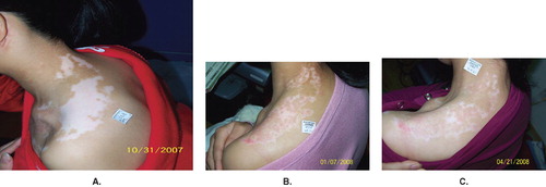Figure 2. (A) Segmental vitiligo on the left shoulder and neck before the second operation; (B) repigmentation gradually took place 2 months after the second operation; (C) approximately 95% of treated vitiliginous skin was repigmented 7 months after the second operation.