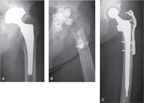 Figure 2. A representative case of periprosthetic joint infection (case 8). A. Preoperative plain radiograph, showing cup migration. B. Plain radiograph after the first operation. Implant removal and antibiotic-loaded hydroxyapatite block replacement were performed. C. Plain radiograph after the second operation.