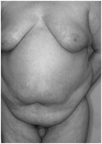 Figure 8. Gynecomastia. Large pending breast with significant submammary fold in a patient with Klinefelter's syndrome.
