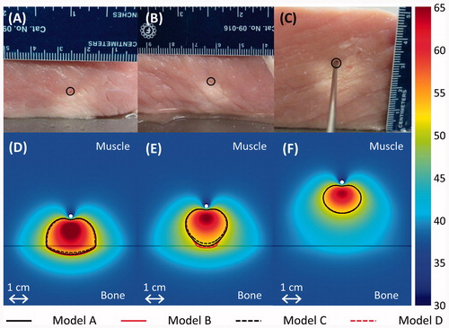 Figure 6. (A–C) Thermal lesions created by 10-min ablations at 12.5 acoustic W/cm2 in porcine muscle positioned directly atop bovine bone, shown in central cross-sections through the lesions. The catheter was measured as 15.2, 19.7, and 32.3 mm away from the bone before heating in A–C respectively, and 11.5, 17, and 32 mm away from the bone after the experiment. The catheter track is circled, and the side of the tissue that was against the bone is shown against the table. In C, a metal rod illustrates the catheter position. (D–F) The experiments were modelled with the applicator 15, 20, and 32 mm away from the bone, respectively, and the results after a 10-min ablation are plotted in the central plane between the two transducers. The resulting temperature profiles produced by model A are shown in a colour map (°C). A black line indicates the bone/muscle boundary, and curves outline the 52 °C temperature contours for models A–D.