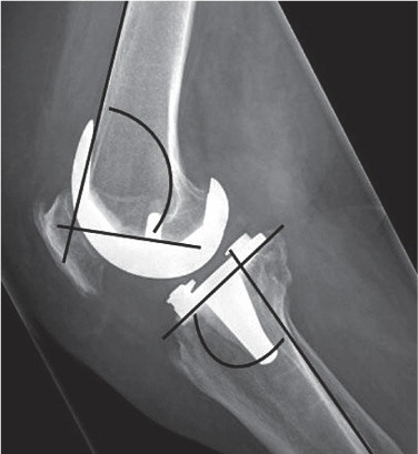 Figure 5. Lateral radiograph showing the LFC and LTC angles. LFC angle was defined as the anterior angle between the femoral component and the cortex of the femur. LTC angle was defined as the angle between the tibial component and the posterior cortex of the tibia.