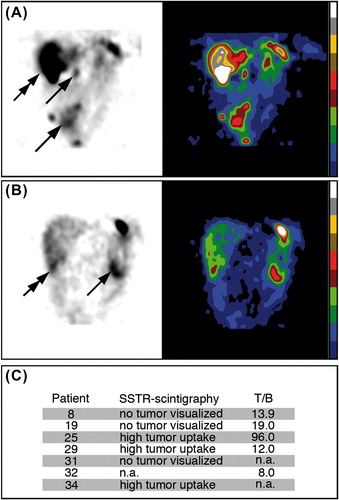 Figure 4. SSTR scintigraphy and tumor-to-blood 111In activity concentration ratios (T/B) in tumor biopsies from GIST patients injected with 111In-DTPA-D-Phe1-octreotide. (A) Tumor imaging of patient no. 25 with primary small intestinal GIST non-radically resected, and multiple abdominal (arrows) and liver (double arrow) recurrences four years after primary surgery. The primary tumor had KIT exon 11 duplication mutation and responded to imatinib. (B) Tumor imaging of patient no. 29 with primary GIST close to the ligament of Treitz (arrow) and multiple liver metastases in the right liver lobe (double arrow). This patient was wt for KIT and PDGFRA and resistant to imatinib. The patient survived for only two years after surgery. (C) Summary of observations at SSTR-scintigraphy and maximal T/B values in GIST patients.