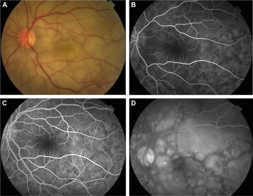 Figure 6 Color retinal and FFA photographs of a patient in the acute phase of VKHD showing (A) hyperemic optic disc with deep yellow lesions of variable size and multiple SRD, (B) early FFA showing delayed choroidal filling, (C) mid phase of FFA showing pinpoint hyperfluorescent leakage at the RPE level (D) with pooling of the dye in the subretinal space in the late phase of the angiogram.