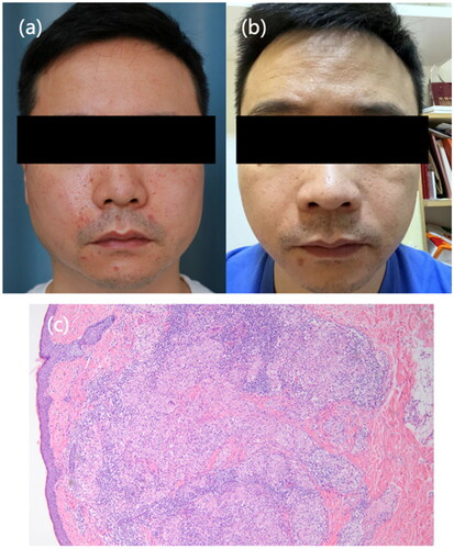 Figure 2. Clinical presentation of Patient 2. (a) Multiple erythematous papules on the central part of the patient’s face at baseline. (b) Nearly resolution of lesions after oral tofacitinib treatment. (c) Routin pathology (hematoxylin eosin, original magnification ×20) showing non-caseating granulomas and lymphocytes infiltrating.