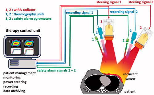 Figure 2. Currently used wIRA-hyperthermia system with two radiators (type hydrosun®-TWH1500) to treat large-size (broad, superficial) breast cancer recurrences. Both radiators are steered independently by two thermographic cameras and safety pyrometers.