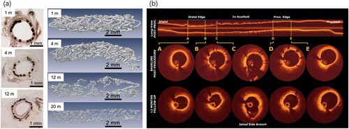 Figure 6. Animal studies and clinical case analysis of Mg-based alloy vascular stents. (a) Haematoxylin-eosin (H&E) staining images and μCT 3D reconstructed images of JDBM (a Mg–Nd–Zn–Zr alloy) stents in rabbit common carotid artery at different time points [Citation407]; (b) Optical coherence tomography 2D images of Magmaris® WE43-alloy-based stent in human coronary artery demonstrated excellent strut apposition with some struts covering the side branch post-implantation; no visible strut remnants exist; and struts initially covering the side branch being resorbed after 12 months [Citation6].