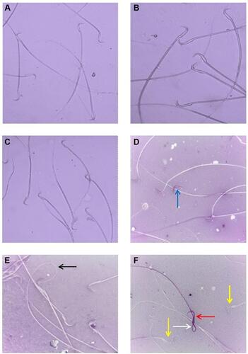 Figure 4 (A, B) sperms of control rats showing normal morphology; (C) sperms of rats exposed to Zn-NPs showing normal morphology; (D–F) sperms of rats exposed to Ag-NPs and Zn-NPs showing a decreased incidence of head and tail deformities and increased viability compared to Ag-NPs group: live sperm (yellow arrow), dead sperm (red arrow), coiled tail (white arrow), curved tail (black arrow) and detached head (blue arrow).