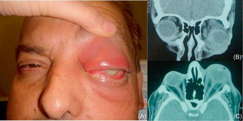 Figure 2. Clinical picture showing proptosis, edema, conjunctival hyperemia and hypopyon (A); coronal (B); and axial (C) computed tomography illustrating proptosis and diffuse orbital infiltrate.