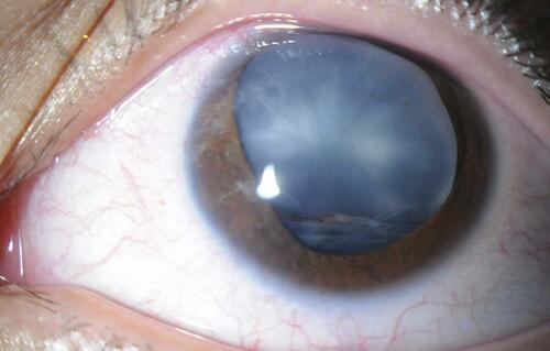 Figure 2 Subluxated cataractous lens in the eye of a person having a firework injury.