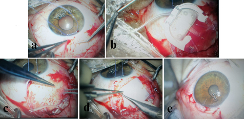 Figure 1 The steps in AGV surgery. (a) Tractional suture with conjunctival dissection. (b) Priming of the AGV. (c) Implantation and suturing of the plate. (d) Pericardial patch covering. (e) The tube in the anterior chamber.