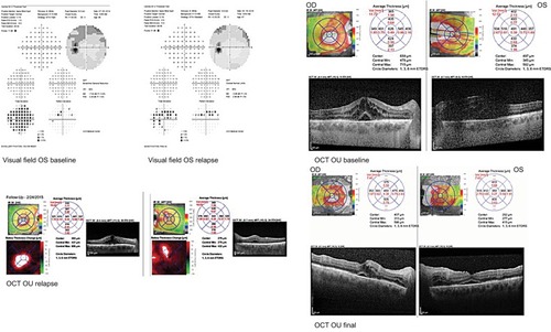Figure 3 Case 3 HVF (baseline) and macular OCT at baseline, relapse, and final visit.