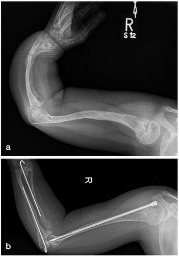 Figure 5. a. Severe deformity of the upper extremity in an 8-year-old patient with OI type III. Double osteotomy of the humerus and telescopic rodding was planned plus a double corrective radius and ulna osteotomy with a K-wire fixation inserted from opposite sides through the growth plates, thus allowing for telescoping.b. Postoperative follow-up at 5 years. The amount of telescoping of the nail in the humerus corresponds with length without K-wire in radius and ulna due to growth.