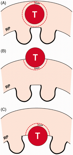 Figure 1. Schematic diagram of a renal tumour and tumour margin according to the location of the tumour. A parenchymal tumour (A) has a greater volume of tumour margin than an exophytic (B) or central (C) tumour in cases where all the tumours are the same size. The parenchymal tumour requires double the ablation of the tumour margin than an exophytic or central tumour that is projecting 50% from the renal parenchyma to the peri-renal space or renal sinus. RP indicates renal parenchyma.