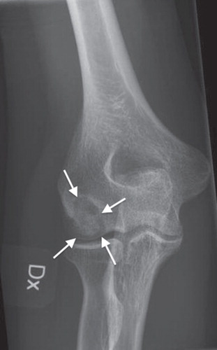 Figure 1. Standard preoperative anteroposterior radiography of the elbow showing the osteonecrotic lesion in the capitulum humeri.