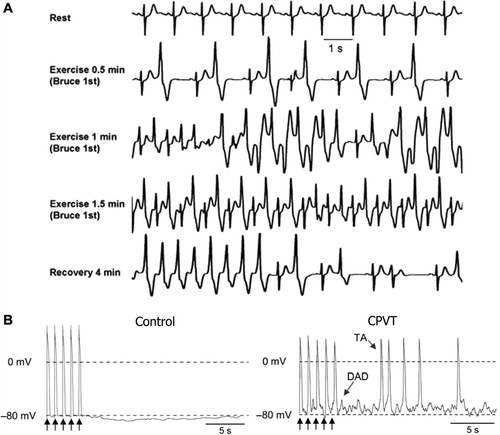 Figure 3. Mechanisms of arrhythmogenesis in catecholaminergic polymorphic ventricular tachycardia. A: Exercise stress test in a patient with polymorphic VT and RyR2 mutation. Ventricular arrhythmias are observed with a progressive worsening during exercise. Typical bidirectional VT develops after 1 minute of exercise with a sinus heart rate of approximately 120 beats per minute. Arrhythmias rapidly recede during recovery. B: AP recordings from control and CPVT stem cell-derived ventricular myocytes. Arrows represent 1 Hz pacing procedure. CPVT shows delayed after-depolarizations (DAD) followed by triggered activity (TA), which is absent in the control. Reproduced with permission from (A) Liu et al., Prog Cardiovasc Dis 2008;51:23–30 (Citation97); (B) Jung et al., EMBO Mol Med 2012;4(3):180–91 (Citation20).