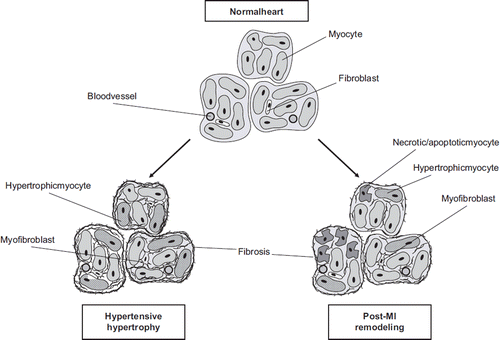 Figure 2. Schematic representation of cellular and molecular changes in the heart during hypertensive hypertrophy and after myocardial infarction. In the hypertensive heart, the hypertrophy of cardiomyocytes and the transition of fibroblasts to myofibroblasts are accompanied by an increase in the amount of ECM, which leads to fibrosis. Inflammation, cell death, and scarring are integral parts of post-MI remodelling associated with subsequent hypertrophy and fibrosis of the non-infarcted area.