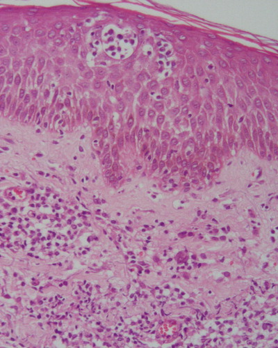 Figure 2.  Mycosis fungoides pattern. Infiltration of atypical lymphocytes in the upper dermis with epidermotropism and Pautrier abscesses (HE, ×160).