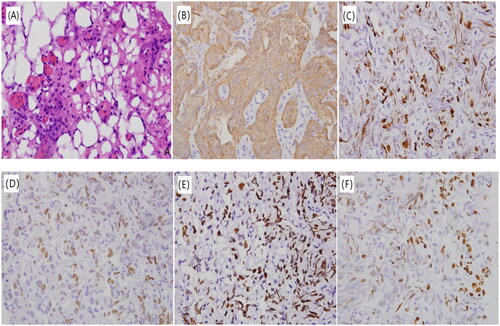 Figure 1. Pathological results of patient after TURBT. (A) HE staining (×400) showed the pathological type of high-grade uroepithelial carcinoma; (B) IHC (×400) showed positive AE1/AE3 expression; (C) IHC (×400) showed positive Ki67 expression (index 80%); (D) IHC (×400) showed positive P40 expression; (E) IHC (×400) showed positive P53 expression, 90%+; (F) IHC (×400) showed shows positive P63 expression.