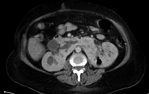 Figure 1. Computerized tomography with contrast showing horseshoe kidney with fusion of lower poles and air in left kidney.
