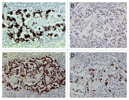 Figure 3. Extra-large diabetic islet, Case 15. This extra-large islet showed less β-cells (A) than α-cells (C). β cells were strongly and granularly immunostained with irregular, fuzzy cell membrane whereas α-cells contained dense positive compact cytoplasm. δ cells consisted of a few large cytoplasm and mostly compact cytoplasm (D). IAPP staining was almost completely negative with only weak residual granular positive staining (B). Stromal amyloid deposits occupied about 20% of the islet area, which was negatively stained for IAPP using a 1: 800 antibody solution (B). (A) Insulin; (B) IAPP; (C) Glucagon; (D) SRIF immunostained; Original magnification X 470.