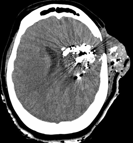 Figure 3 Axial view of the CT showing left-sided extracranial cerebral herniation and retained bullet fragments.