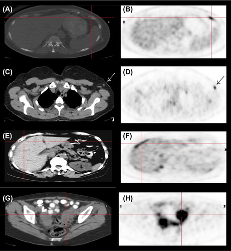 Figure 2. Axial views of 18F-FDG PET/CT show: (A and B) a highly intense focus (SUV max 10.5) (B) in a small lytic lesion in the left rib anteriorly (red cross); (C and D) a highly intense (SUV max 10) focus in a small lymph node in the left axilla (arrows); (E and F) an elongated pathological uptake (SUV max up to 13) in the peritoneal spread around the liver (red cross); (G and H) high accumulation of FDG (SUV max up to 14) in large implants in both ovary (red cross).