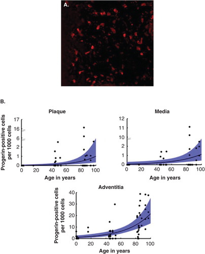Figure 4. PRF Cell and Tissue Bank has contributed to studies showing the presence of progerin in normal aging skin and normal aging vasculature. A. Red stain detects progerin in cells of a skin biopsy from a 90-year old; B. Progerin detection in three layers of the vascular wall increases with age.
