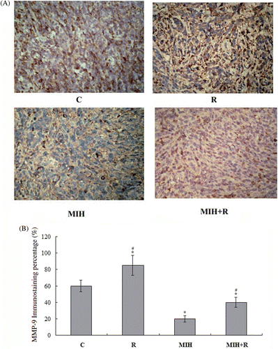 Figure 4. Immunohistochemical detection of MMP-9 expression in the primary tumour. (A) Immunohistochemical analyses were performed to determine MMP-9 expression in the primary tumour at the 4T1 cell injection site 25 days after the treatments. Positive staining for MMP-9 was brownish in colour. Magnification, ×200. (B) MMP-9 positive cells were counted and a percentage was calculated as follows: MMP9 positive cells/total tumour cells × 100%. The MMP-9 immunostaining percentage in the tumour was compared among treatment groups: C, tumour-bearing control; R, radiotherapy; MIH, magnetic induction hyperthermia; MIH + R, magnetic induction hyperthermia plus radiotherapy. *P < 0.05 compared with group C; #P < 0.05 compared with group MIH + R.